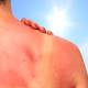Proper treatment of sunburned skin is essential for faster recovery and minimizing damage.