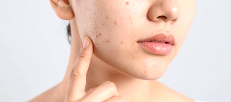 Effectively reduce hidden acne: build a proper skincare routine starting from the basics.