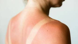 How to soothe sunburned skin with spinach: a natural and easy-to-apply home remedy.