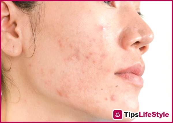 images 1 of Effectively reduce hidden acne: build a proper skincare routine starting from the basics.