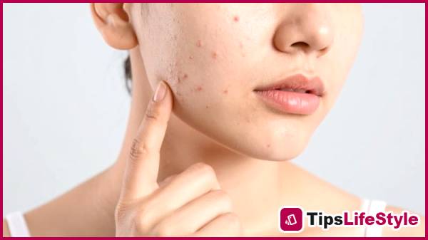 images 2 of Effectively reduce hidden acne: build a proper skincare routine starting from the basics.