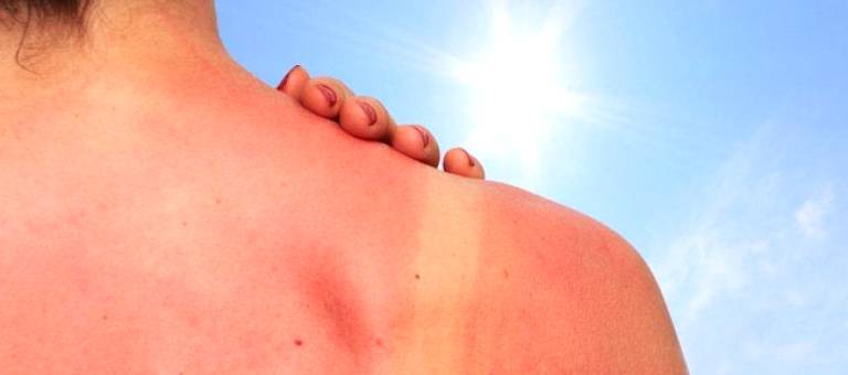 Proper treatment of sunburned skin is essential for faster recovery and minimizing damage.