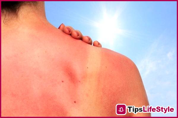 images 2 of Proper treatment of sunburned skin is essential for faster recovery and minimizing damage.