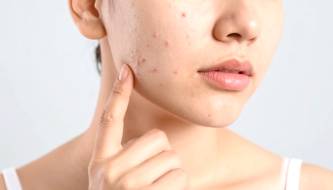 Effectively reduce hidden acne: build a proper skincare routine starting from the basics.