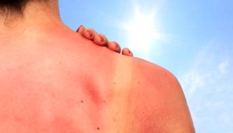 Proper treatment of sunburned skin is essential for faster recovery and minimizing damage.